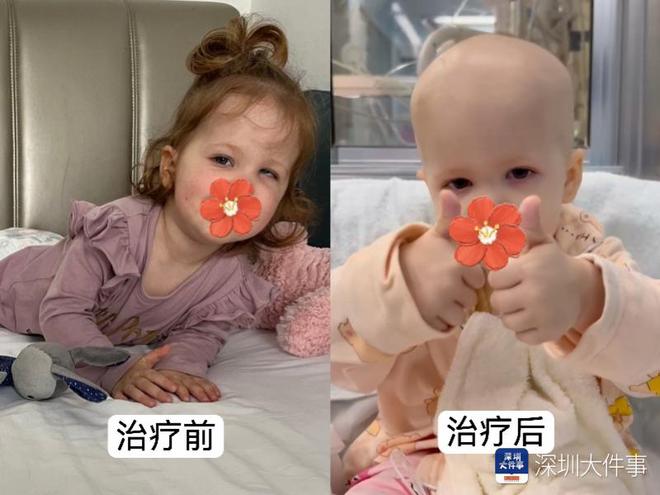 基因治療“逆天改命”！瑞典罕見遺傳病患兒萬里赴粵重獲新生(圖2)