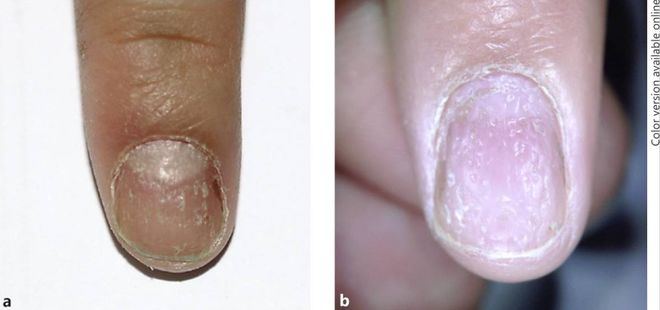 孩子指甲軟薄易斷、月牙少、長白點、豎紋是顯示身體有健康風(fēng)險嗎？(圖7)