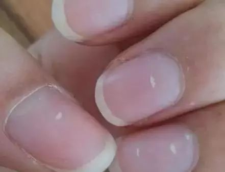 孩子指甲軟薄易斷、月牙少、長白點、豎紋是顯示身體有健康風(fēng)險嗎？(圖6)