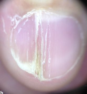 孩子指甲軟薄易斷、月牙少、長白點、豎紋是顯示身體有健康風(fēng)險嗎？(圖11)