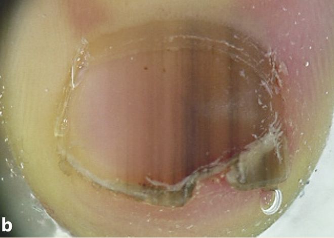 孩子指甲軟薄易斷、月牙少、長白點、豎紋是顯示身體有健康風(fēng)險嗎？(圖8)