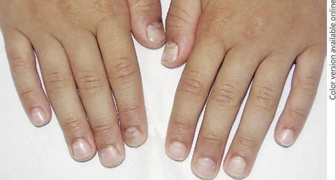 孩子指甲軟薄易斷、月牙少、長白點、豎紋是顯示身體有健康風(fēng)險嗎？(圖10)