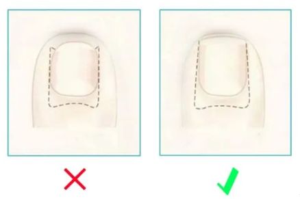 孩子指甲軟薄易斷、月牙少、長白點、豎紋是顯示身體有健康風(fēng)險嗎？(圖13)